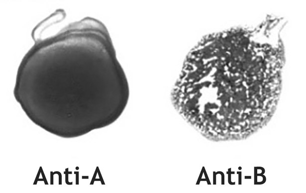 <p>8. Before performing a red blood cell transfusion, the patient’s blood group must be checked using a bedside test and compared with the label on the blood unit.</p><p>Which result does the section of the bedside test in the figure show?</p><p>A. Blood group A</p><p>B. Blood group B</p><p>C. Blood group AB</p><p>D. Blood group O</p><p>E. Rhesus factor positive (Rh⁺)</p>