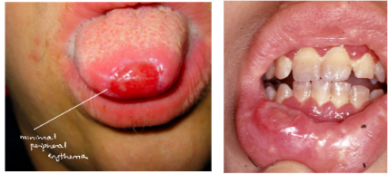 <p><span style="background-color: transparent; font-family: "Times New Roman", serif;">*<strong>Bacterial</strong> > Viral/Fungal infections</span></p><p><span style="background-color: transparent; font-family: "Times New Roman", serif;"> - may demonstrate reduced suppuration/abscess formation</span></p><p><span style="background-color: transparent; font-family: "Times New Roman", serif;"> - Common infection site = middle ear, oral cavity, perirectal area</span><br></p><p><span style="background-color: transparent; font-family: "Times New Roman", serif;">ORAL:</span></p><p><span style="background-color: transparent; font-family: "Times New Roman", serif;"><strong>*<u>Infection of oral mucosa may be initial sign!</u></strong></span></p><p><span style="background-color: transparent; font-family: "Times New Roman", serif;"><strong>*Ulcerations</strong> (minimal peripheral erythema, usually gingiva, </span></p><p><span style="background-color: transparent; font-family: "Times New Roman", serif;">biopsies show neutrophilic infiltrate)</span></p><p><span style="background-color: transparent; font-family: "Times New Roman", serif;"><strong>*Premature periodontal disease</strong></span></p>