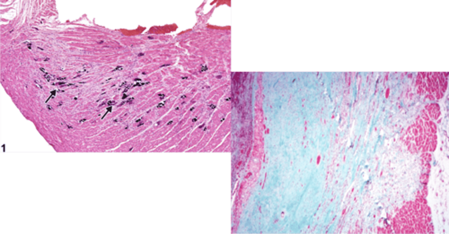 <p>Myocardial fibrosis (&gt; 12-20 days) is characterized by what microscopically?</p>