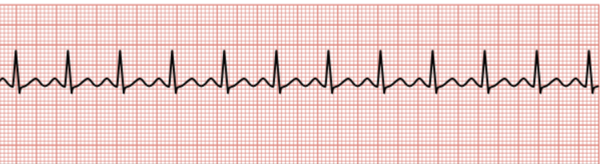 <p>Heart rate greater than 100/min.</p>