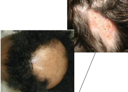 <p>shiny skin, complete loss of hair follicles, and discoloration</p>