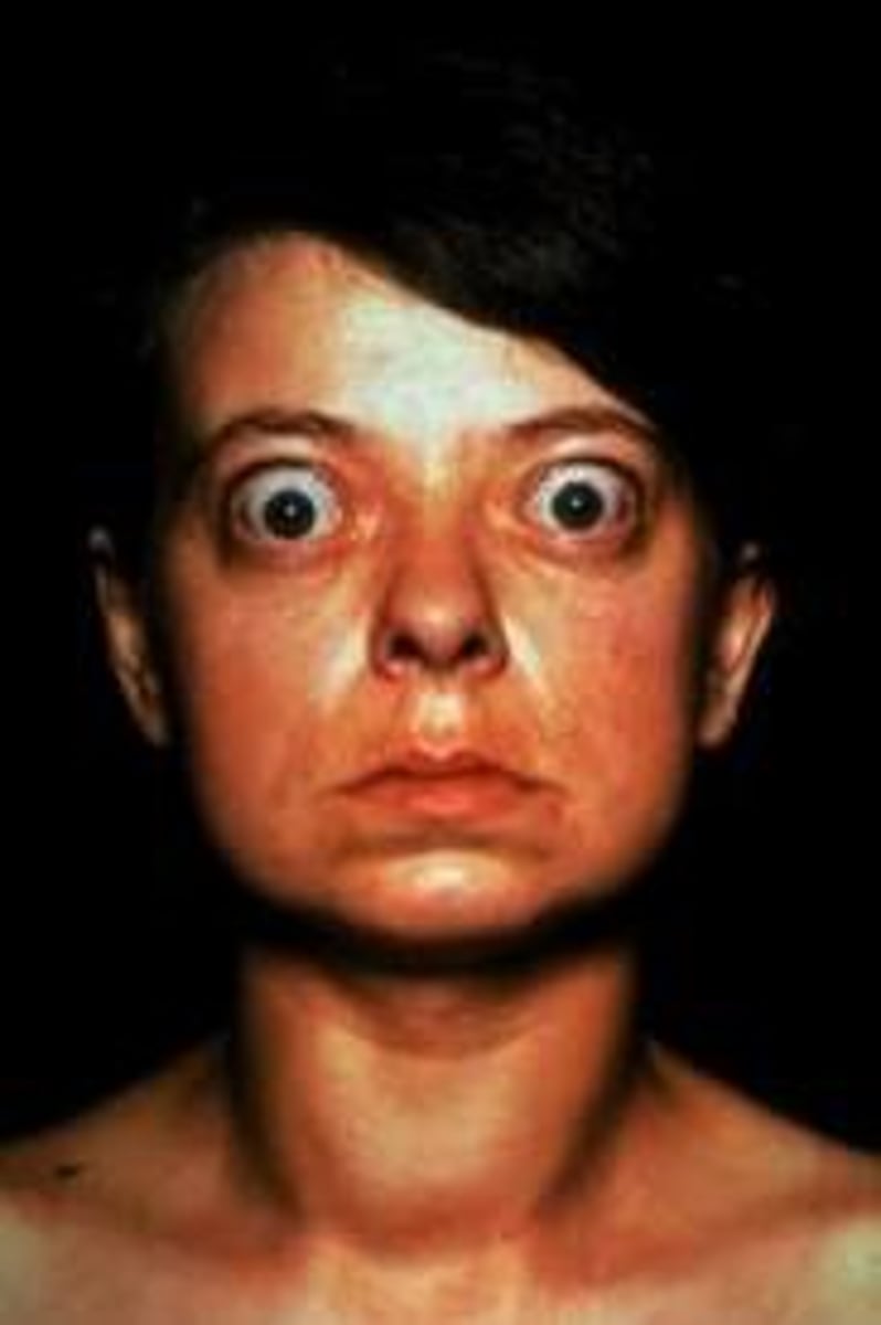 <p>Most common cause of hyperthyroidism</p>