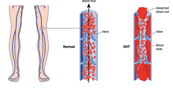 <p>När det uppstår en rubbning i pro-koagulanta vs anti-koagulant faktorer i kroppen får man <strong>venös tromboemboli (VTE).</strong></p><ul><li><p><strong>Deep vein trombosis: </strong>DVT. Drabbar oftast nedre extremiteter och ibland armar (4%). <strong> </strong></p></li><li><p><strong>Tromboflebit: </strong>Tromb som uppstår i en ytlig ven. </p></li><li><p><strong>Flegmasi: </strong>En stor proximal tromb i benet som orsakar arteriell insufficiens eller kompartmentsyndrom. </p></li></ul>