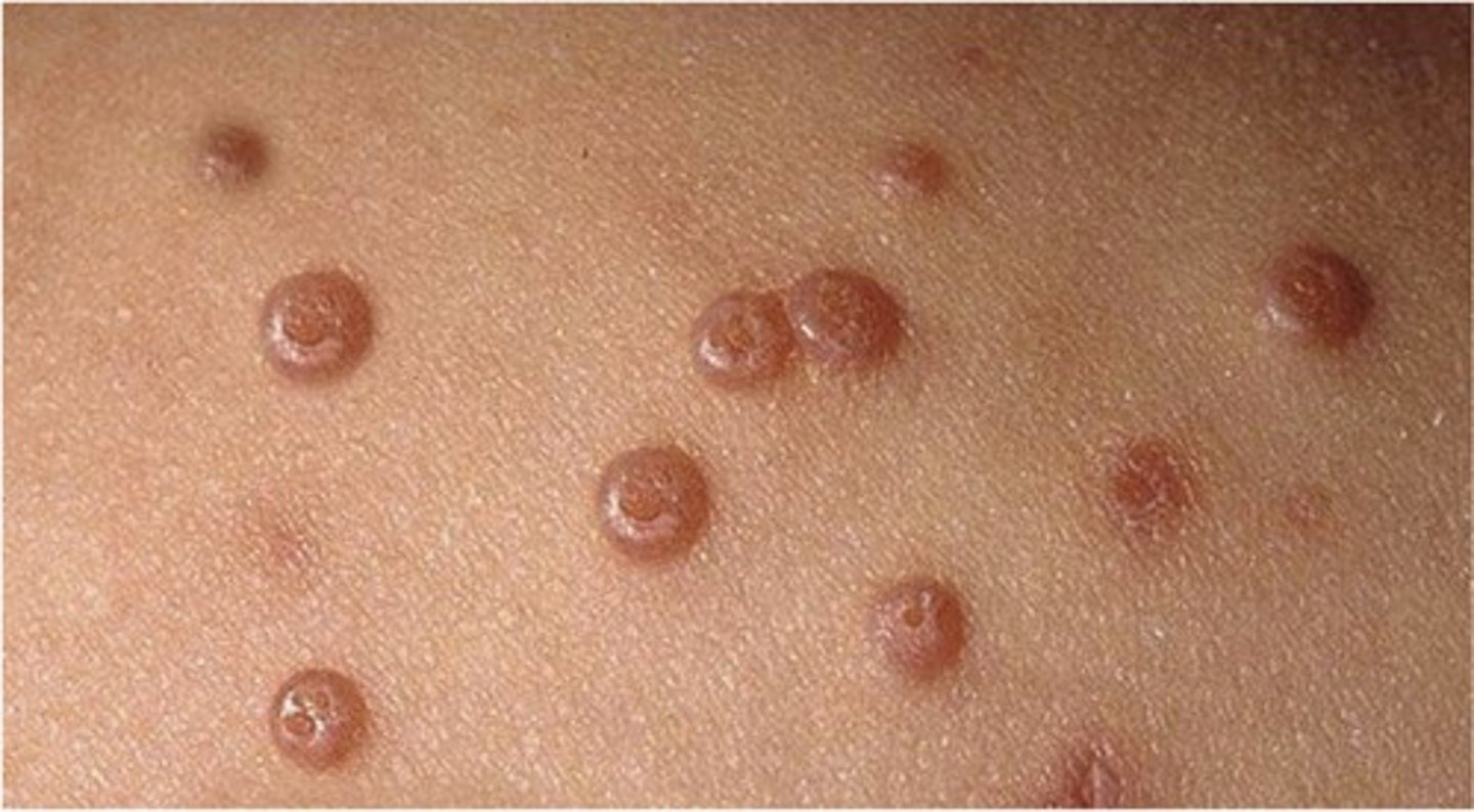 <p>these are flesh colored and dome shaped papules with central core/umbilication</p>