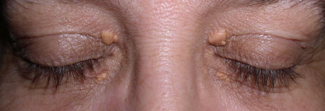 <p>One of the normal findings in <strong><em>4. Position of the eyelids in comparison with the eyeballs</em></strong></p><ul><li><p>Raised yellow plaques located most often near the inner canthus</p></li><li><p>Normal variation associated with increasing age and high lipid levels</p></li></ul><p></p>