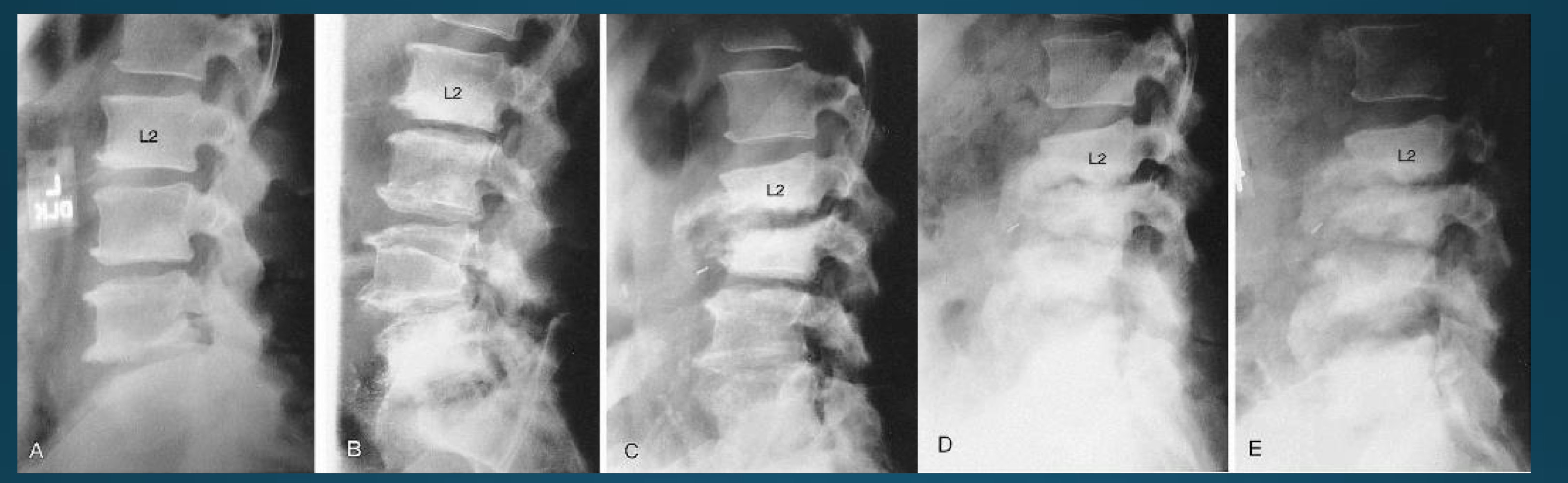 <p>what would this charcot joint be caused by </p>