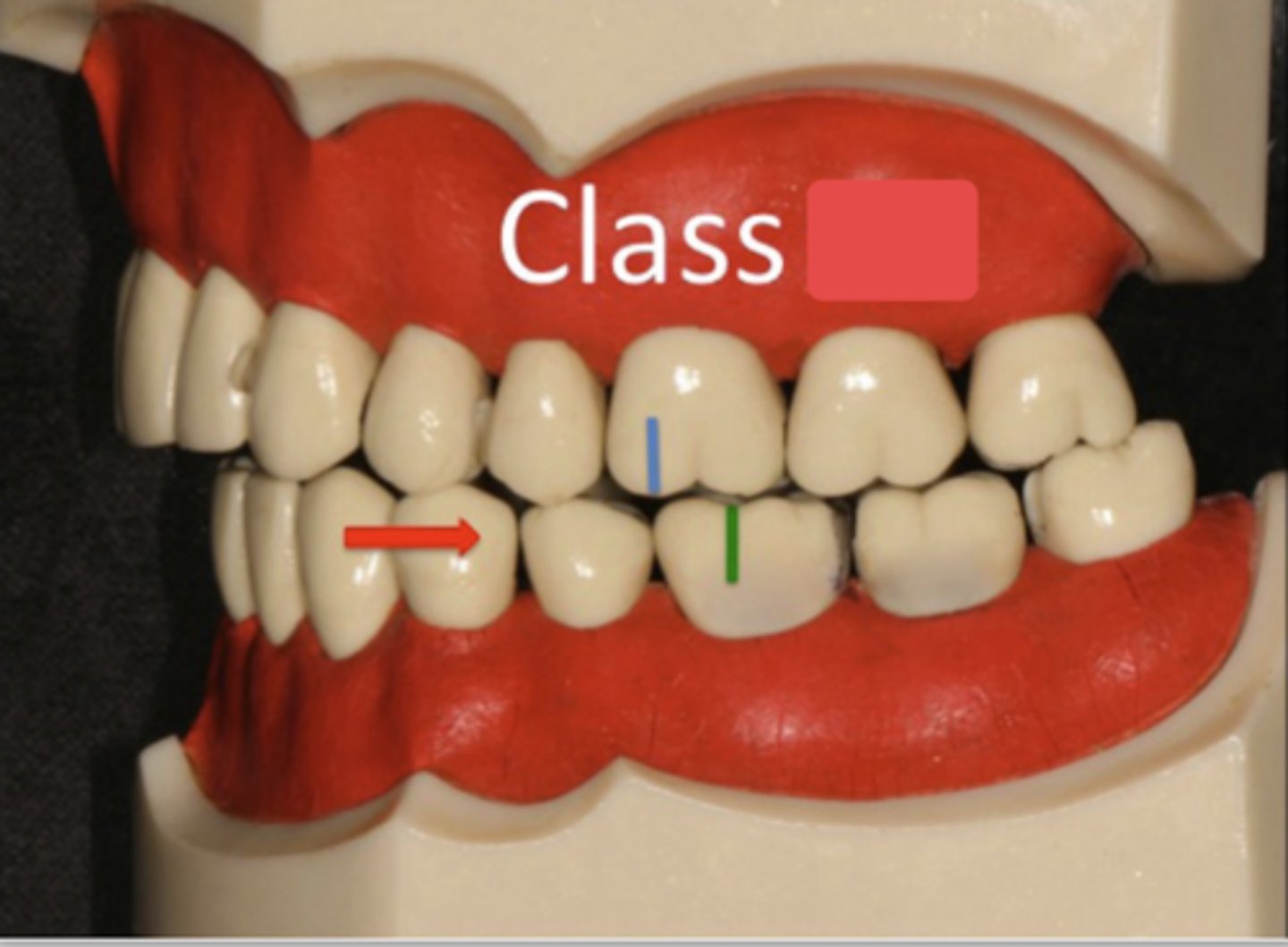 <p>ID the occlusion classification:</p>