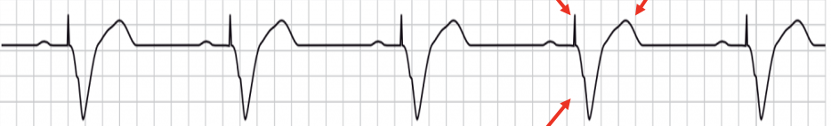 <p>pacer spike followed by a wide QRS complex and contralateral T wave</p>