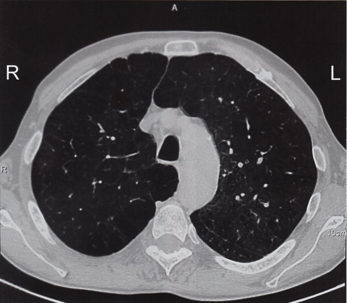 <p>E. Increase in residual volume</p>