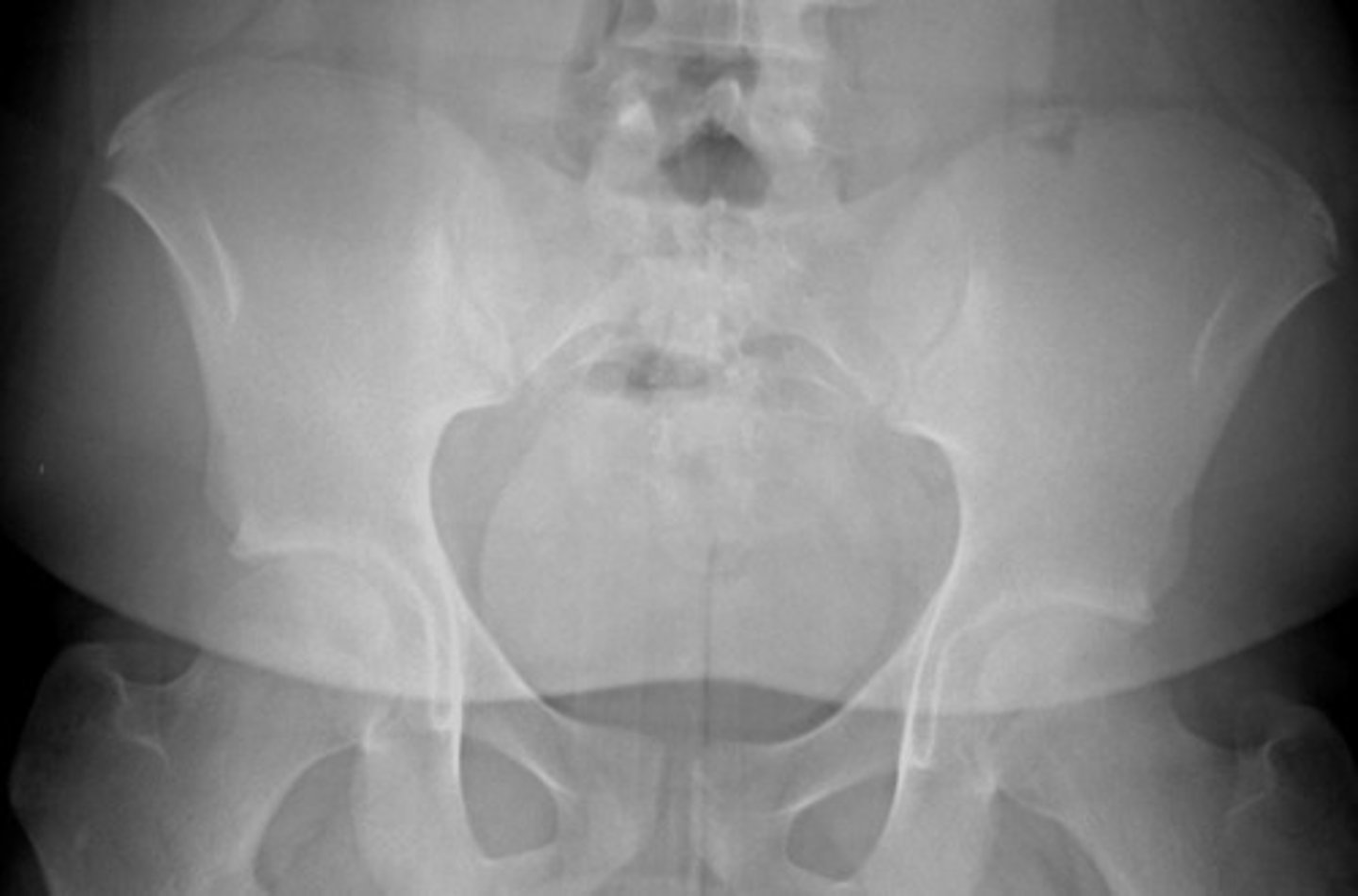 <p>What grade Risser sign is this?</p>