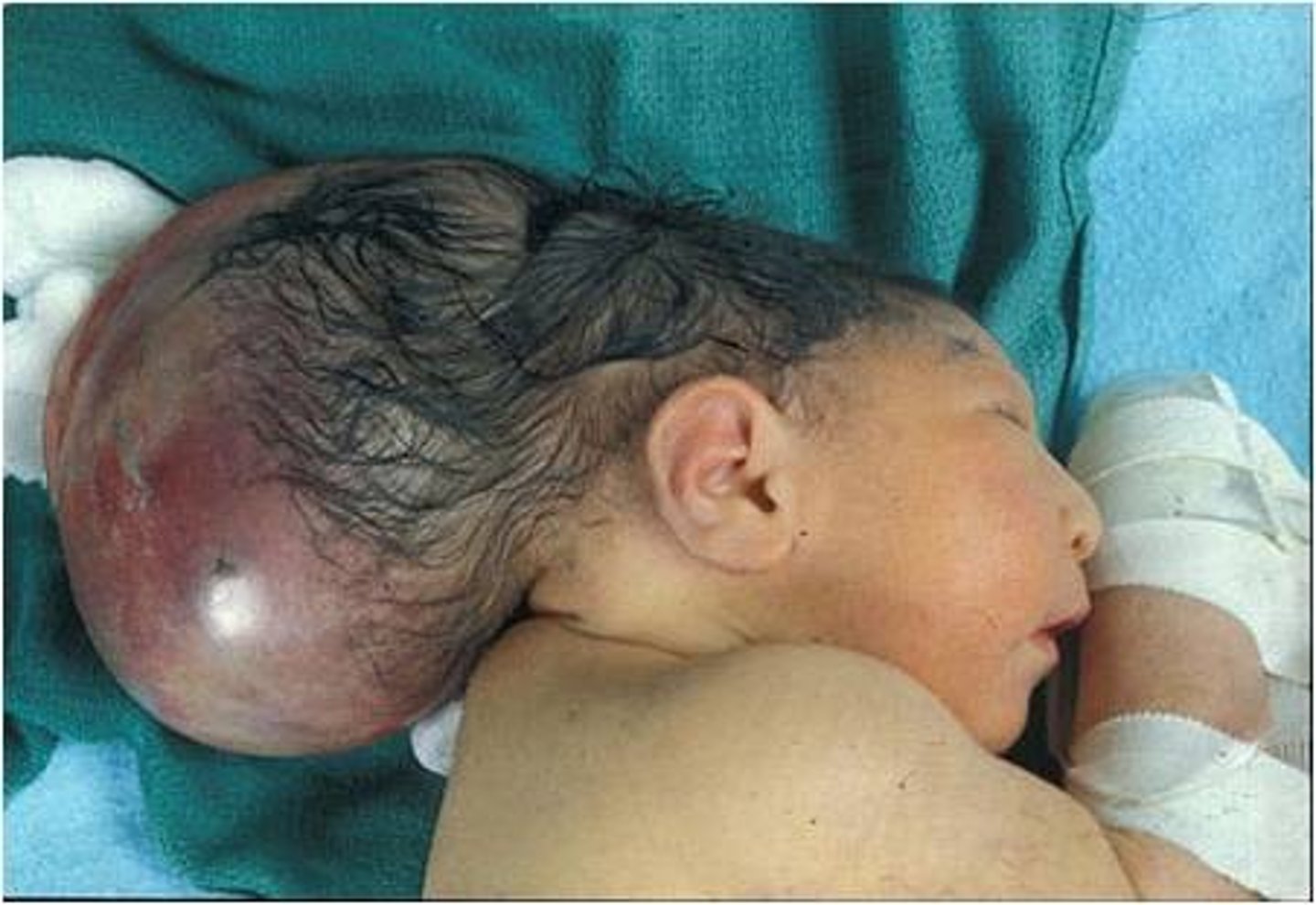 <p>Herniation of brain and meninges through defect in the skull producing a fluid-filled sac</p>