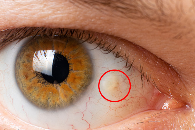<p>PP: yellowish triangular nodule in bulbar conjunctiva</p><p>E: aging<br>appear first on nasal to temporal side</p>