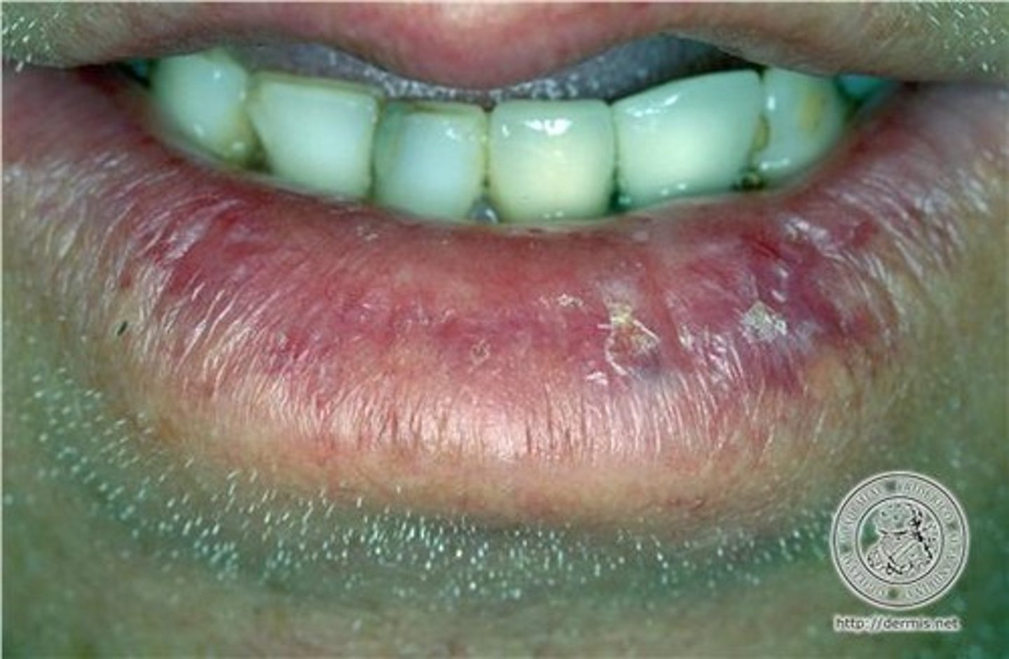 <p>scaly thickened everted lip</p>