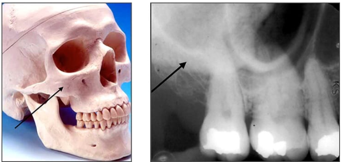 <p>Zygoma/Zygomatic bone </p><ul><li><p>articulates with the zygomatic process </p></li><li><p><u>Radiography: </u><strong><u>diffuse, radiopaque band </u></strong><u>extended posteriorly from the zygomatic process of the maxilla </u></p></li></ul><p></p>