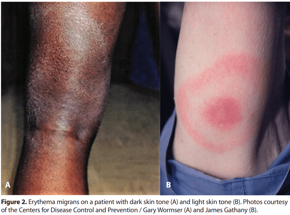 <ol><li><p>light skin: redness </p></li><li><p>dark skin: reddish brown, gray, or purplish like a bruise</p></li></ol><p></p>