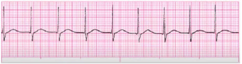 <p>rate 61-100</p><p>no tx (NSR rate)</p><p>can be caused by MI, post-cardiac surgery, RHD, COPD, hypokalemia, dig toxicity</p>