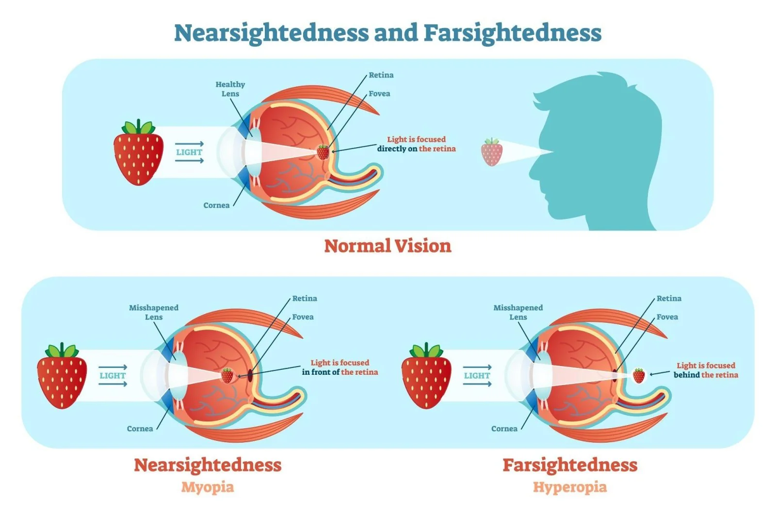 <ul><li><p>Myopia = nearsightedness = Can’t see FAR objects because the image will form BEFORE retina</p><ul><li><p><strong>corrected with CONCAVE lenses</strong></p></li></ul></li><li><p>Hyperopia = farsightedness = Can’t see CLOSE objects because the image will form BEHIND retina</p><ul><li><p><strong>corrected with CONVEX lenses</strong></p></li></ul></li></ul><p></p>