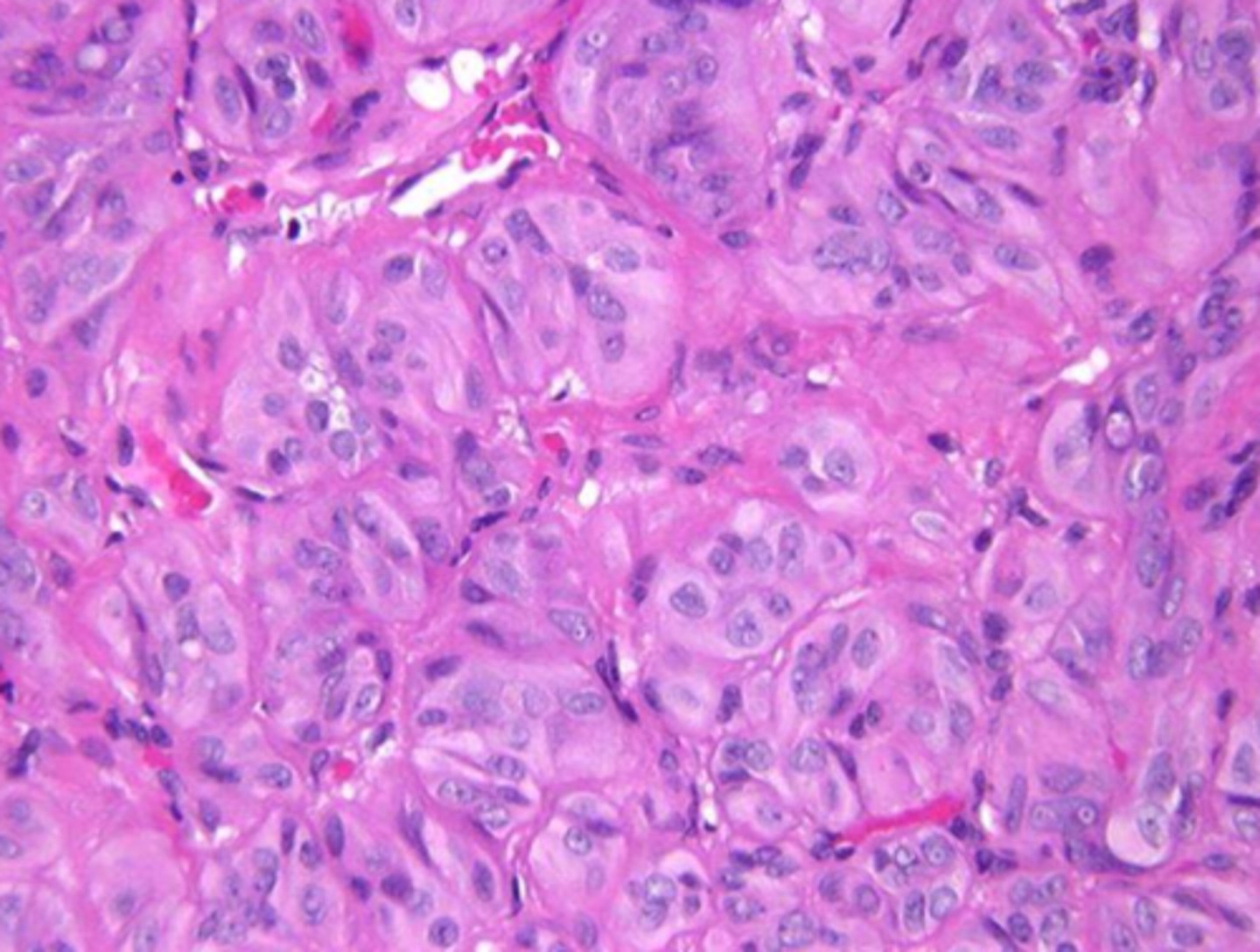 <p>subtype of follicular adenoma with cords or trabeculae with few follicles</p>