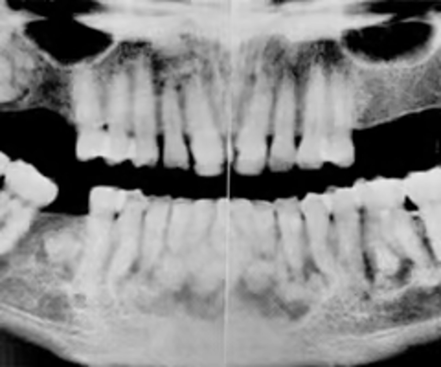 <p>ID the pathology based on radiographic features:</p><p>- Multiple mixed density/radiopaque masses</p><p>- More than 1 quadrant of tooth-bearing areas</p><p>- Varying amounts of radiolucent areas</p><p>- Cotton-wool appearance</p><p>- Concurrent traumatic bone cysts</p>