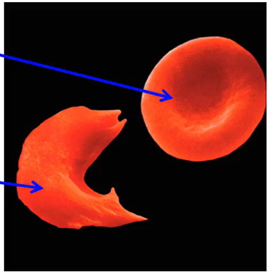 <p>sickle-shaped RBC with hard, nonflexible cell membranes</p>