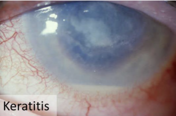 <p>Inflammation of the cornea.; may lead to blindless</p>