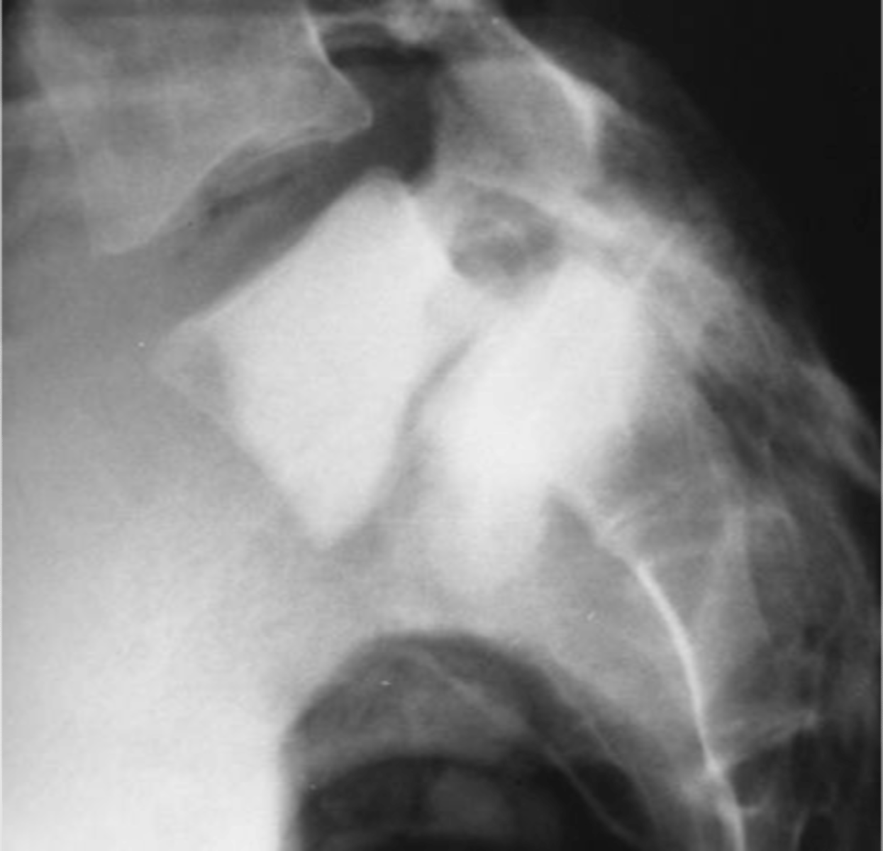 <p>ID complication of degenerative lumbar spine disease</p>