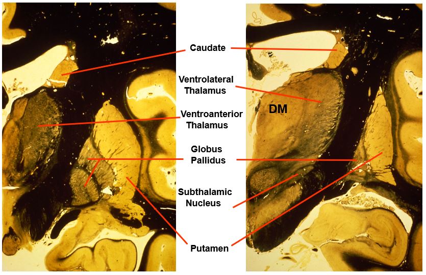 <p>includes:</p><ul><li><p>caudate</p></li><li><p>ventrolateral thalamus</p></li><li><p>ventroanterior thalamus</p></li><li><p>globus pallidus</p></li><li><p>putamen</p></li><li><p>subthalamic nucleus</p></li></ul><p></p>