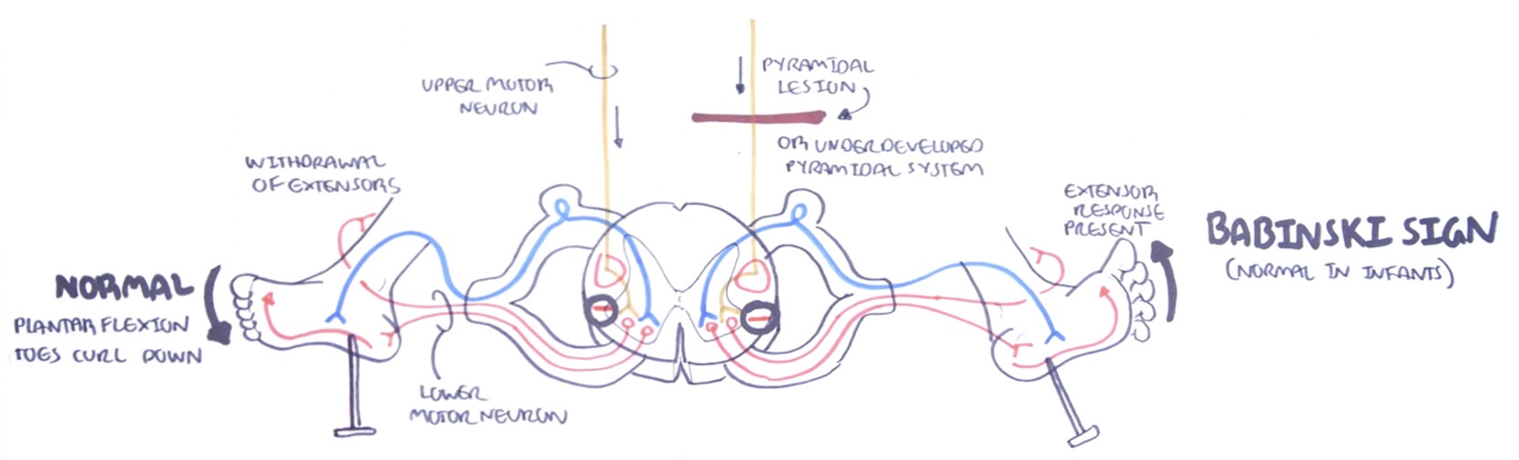 <p><strong>Pyramidal lesions</strong> (or an underdeveloped pyramidal system) cause upper motor neurons to <strong>NOT</strong> inhibit the extensor plantar muscles resulting in <strong>abnormal muscle contraction</strong> which <strong>fans the toes out</strong> and <strong>curls them upward</strong></p>