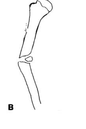 <p>Indirect fractures Angulation </p>