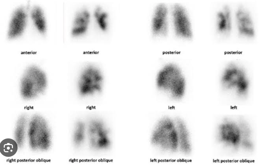 <ul><li><p>It is used to compare ventilation and perfusion. Images of the airways taken after the inhalation of radiolabeled tracers are compared with images of the pulmonary vasculature taken after the injection of contrast agents. </p></li><li><p>Normally, ventilated and perfused areas match. <strong><em>This test is commonly used to identify pulmonary emboli.</em></strong></p></li></ul>
