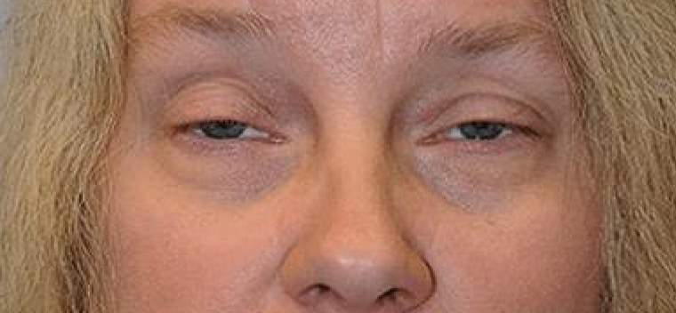 <p>What eyelid position condition is this?</p>