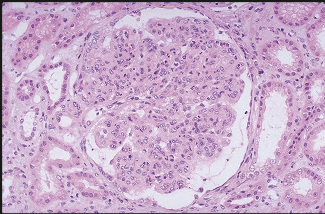 <p>Glomérulos hipercelulares de gran tamaño</p><ul><li><p>Infiltración de leucocitos (es global y difuso osea en tdoso los lóbulos de todos los glomérulos)</p></li><li><p>Proliferación de células endoteliales y mesangiales</p></li><li><p>Formación de semilunas</p></li></ul><p></p>