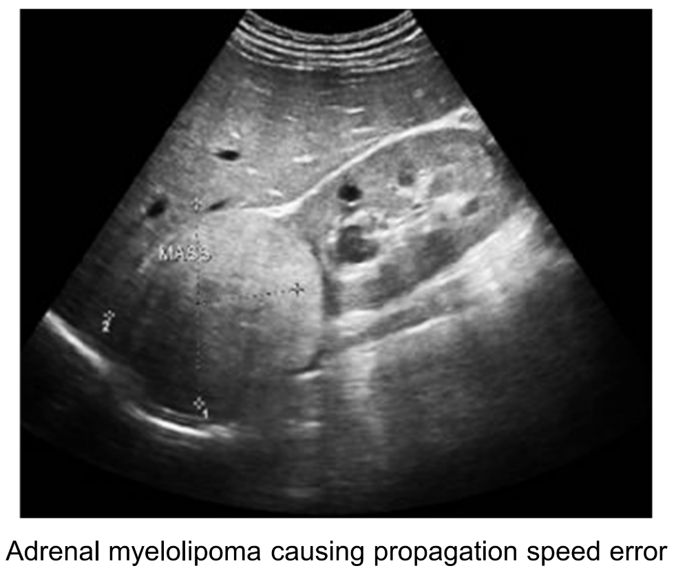 <p>Mislocation of interfaces deep to tissue that has a different propagation speed.</p>