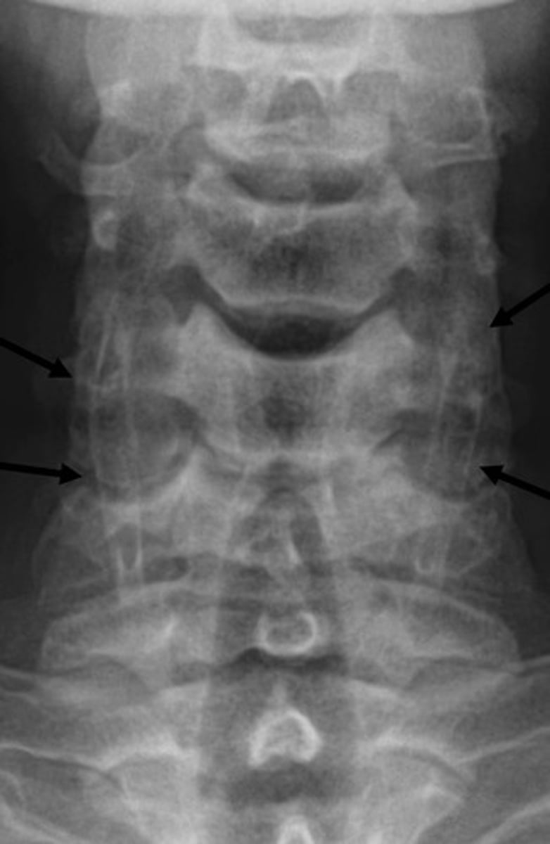 <p>No clinical significance</p>