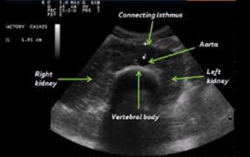 <ul><li><p>Kidneys are joined at the lower poles</p></li><li><p>Isthmus lies anterior to the aorta at the level of L4-L5</p></li></ul><p></p>