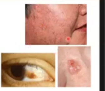 <p> malignant tumors </p>