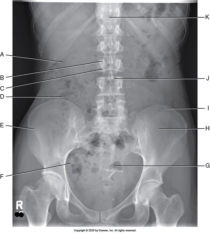 <p>Identify the labeled anatomy "I" in the AP supine abdomen projection</p><p>Sacrum</p><p></p><p>Pedicle</p><p>&nbsp;</p><p>Pubis symphysis</p><p>&nbsp;</p><p>Iliac crest</p>