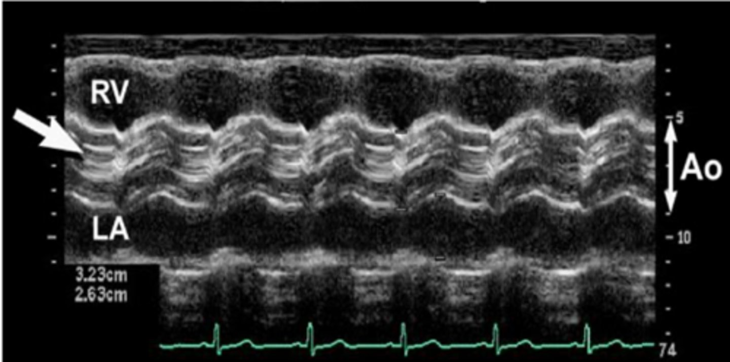 <p>cusp missing from AoV; aortic valve closure line is ECCENTRIC (not centered) and thicker</p>