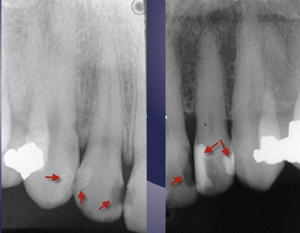 <p>which restorative material?</p>