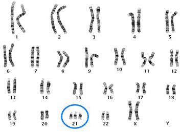 <p>Down Syndrome mutation:</p>