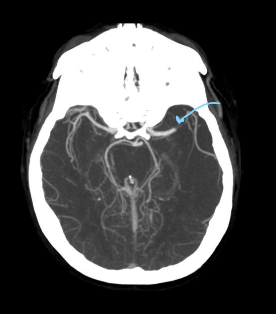<p>Stroke, arteriovenous malformations, stenosis, dissection, and vessel occlusion.</p>