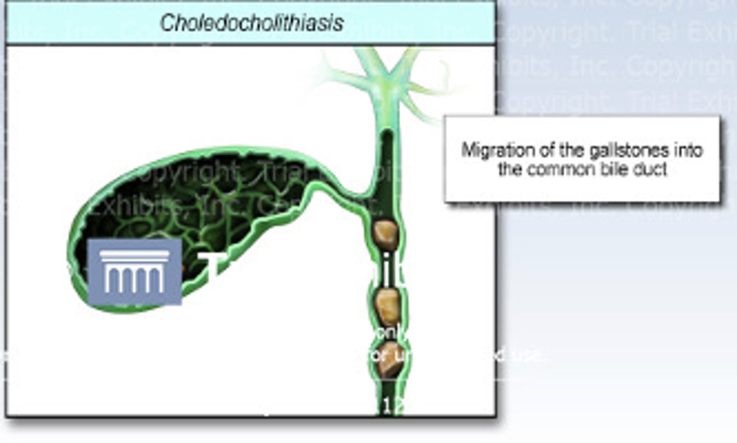 <p>the presence of gallstones within the common bile duct</p>