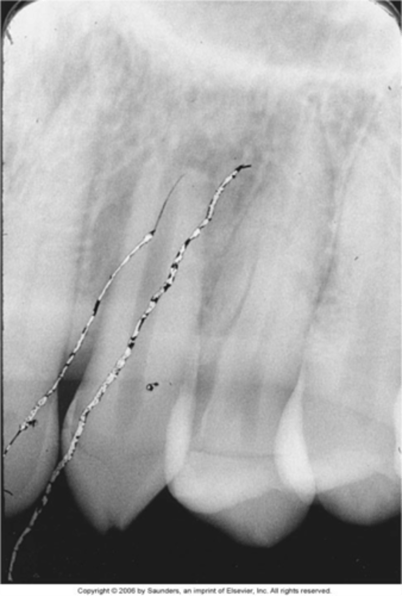 <p>white lines</p><p>soft emulsion removed from film by sharp object</p>