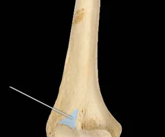 small, lateral hollow on anterior side of distal end 