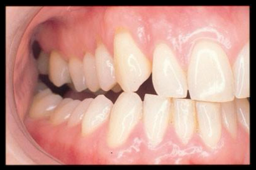<p>in this image, what are the the laterotrusive contacts?</p>