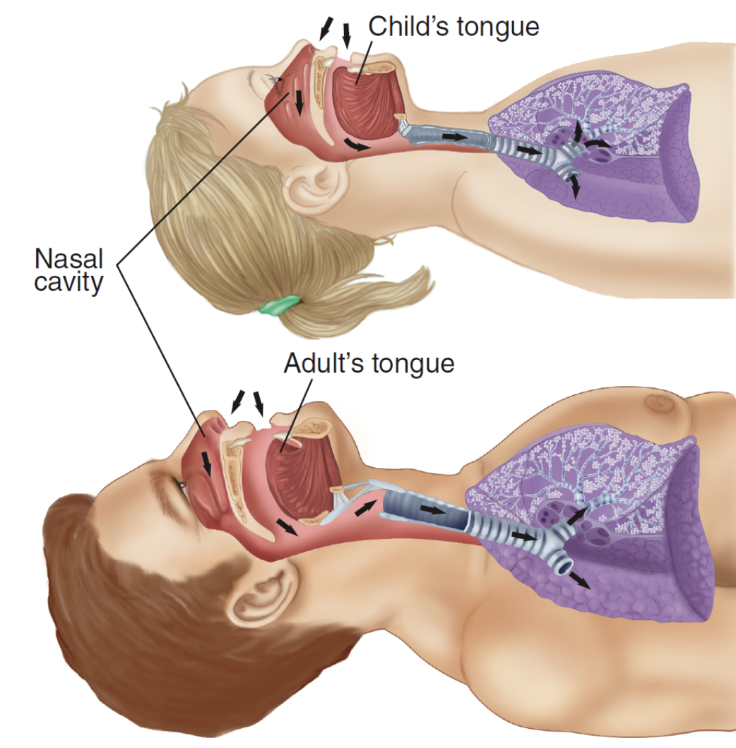 <p></p><ul><li><p><span>Smaller lungs, heart’s higher in the chest</span></p></li><li><p><span>Glottic opening (vocal cords) - higher, more anterior</span></p></li><li><p><span>Long, floppy, U-shaped epiglottis</span></p></li><li><p><span>Larger/rounder occiput</span></p></li><li><p><span>Larger tongue, more anterior</span></p></li><li><p><span>Less developed rings of cartilage in the trachea - collapses if the neck is hyperextended</span></p></li></ul><p></p>