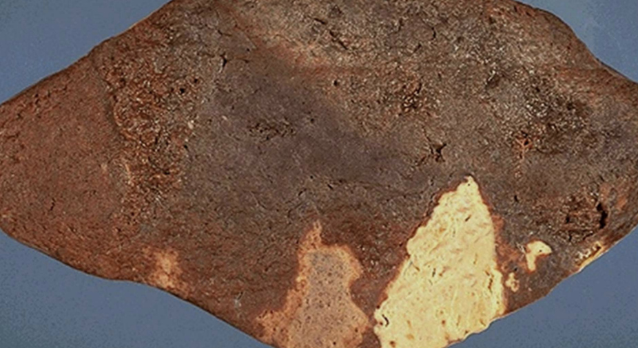<p>Preservation of tissue architecture with protein denaturation; typical of ischemic/anoxic injury to solid organs. <strong>Most common necrosis</strong></p>