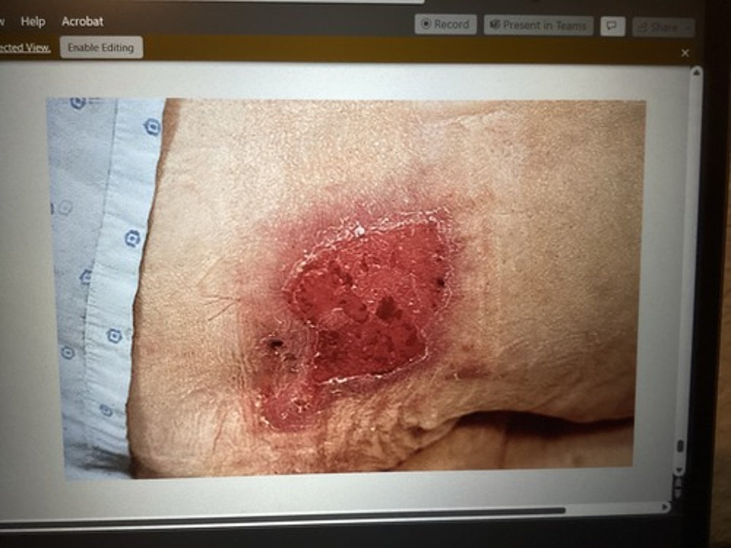 <p>stage 2</p><p>Encourage regeneration of tissue &amp; protect wound surface.</p>