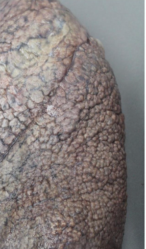 <p>Fibrosis pulmonar idiopática, aspecto</p>