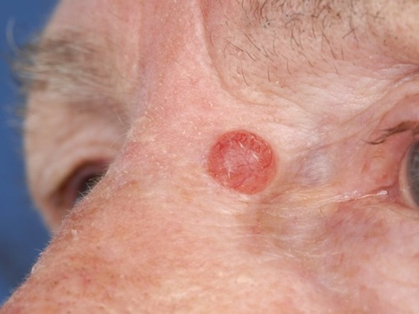 <p>Hoe heet dit klinisch beeld?</p>